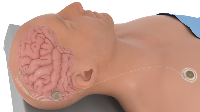 Microelectrode arrays are often surgically inserted on the surface of the brain in the sensorimotor cortex.