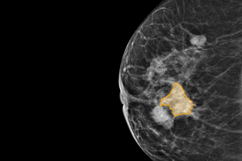 Medical scan imagery showing a cancerous mass 