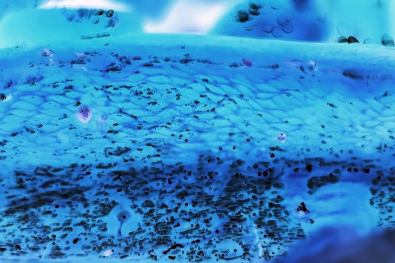 Cancer cells